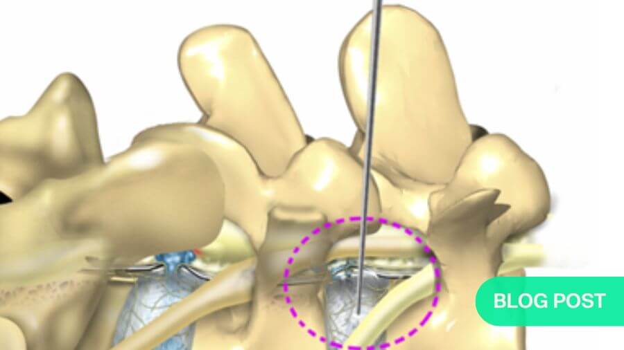 2025_02_blog_tlif_morgenstern_900x506