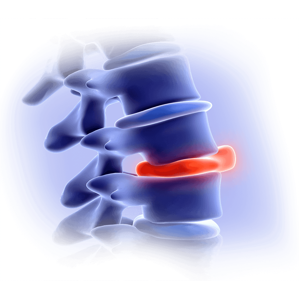herniated disc Max more spine