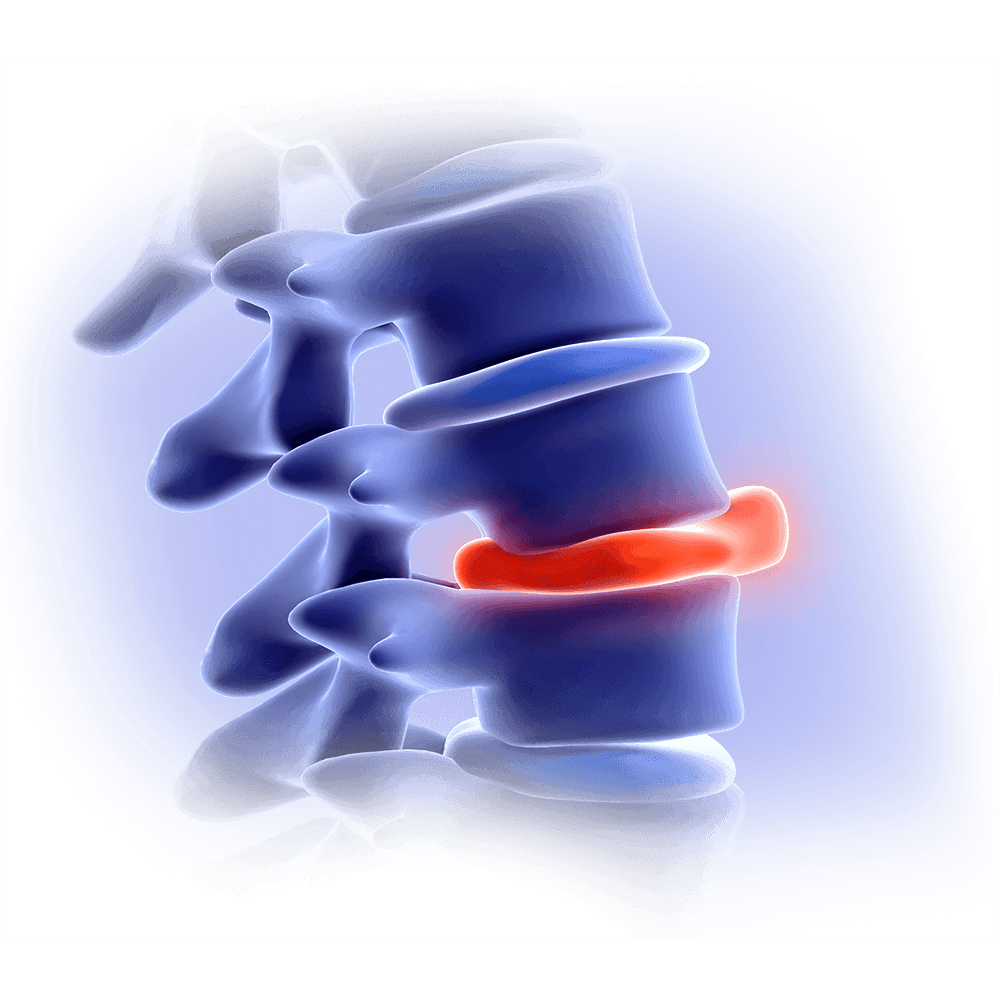 Sciatica and Endometriosis
