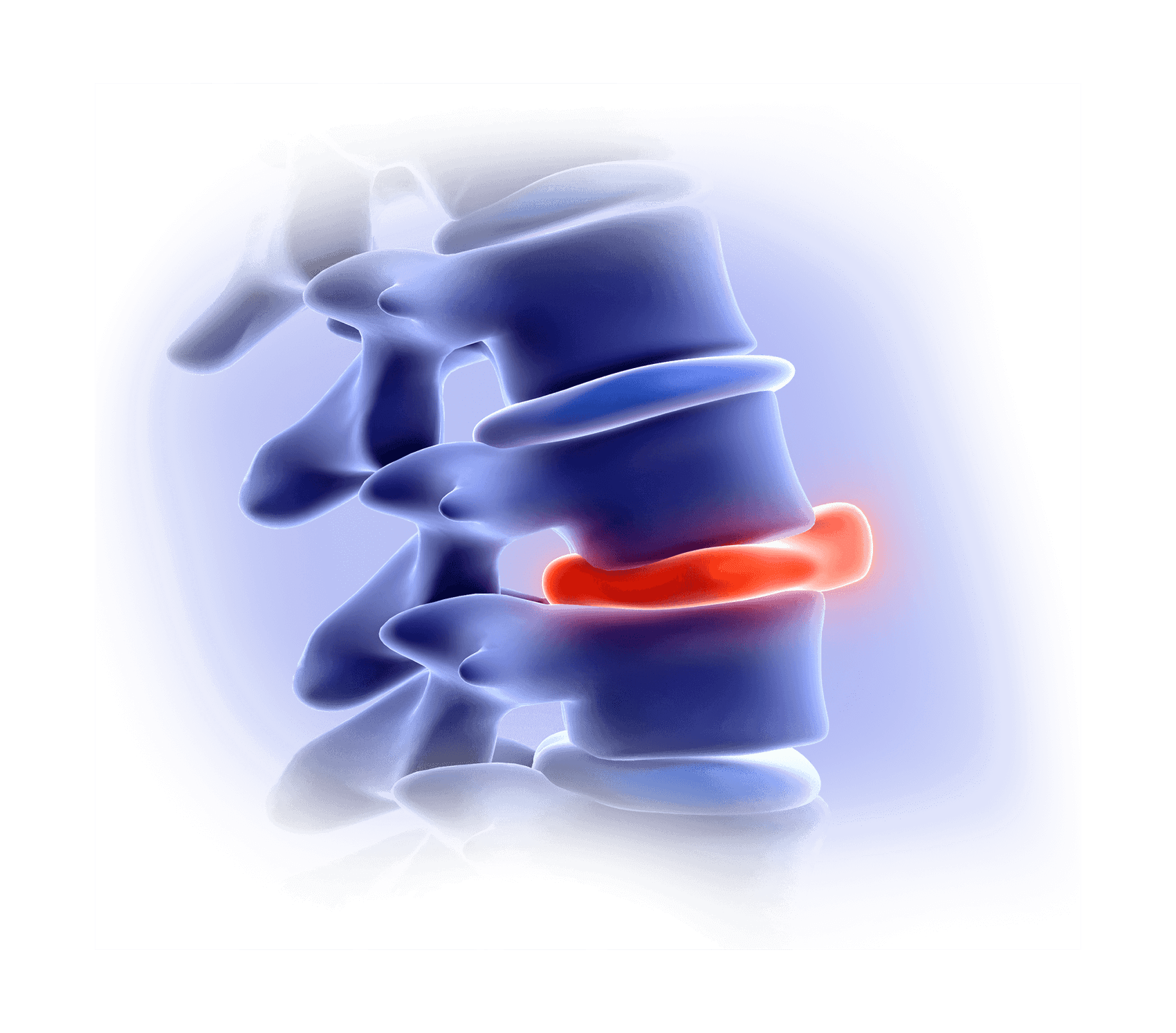 Spine surgery